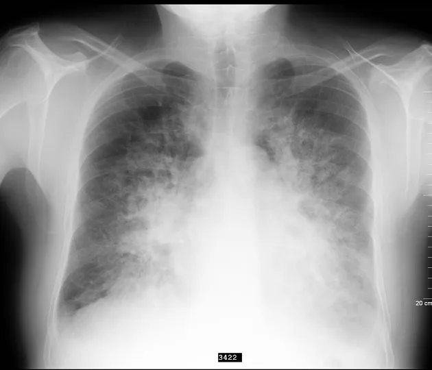 A frontal chest X-ray from a Radiordle puzzle